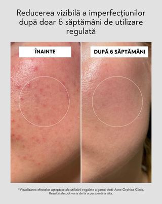 Toner de față cu niacinamidă și acid azelaic Anti-Acne Orphica Clinic 200 ml - 6