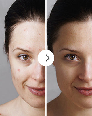 Tablete pentru acnee, coșuri și imperfecțiuni cu zinc, vitamina C, E și B2 Derminax_3 - 3