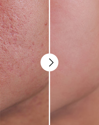 Tablete pentru acnee, coșuri și imperfecțiuni cu zinc, vitamina C, E și B2 Derminax_4 - 4