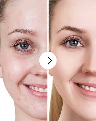 Acne, borbulhas e imperfeições em comprimidos com zinco, vitamina C, E e B2 Derminax_6 - 5