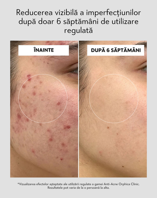 Peeling de față cu niacinamidă, pantenol, BHA și microgranule Anti-Acne Orphica Clinic 100 ml - 5
