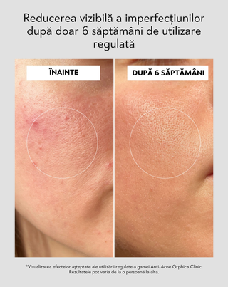 Cremă de zi anti-acnee cu acid salicilic și azelaic Anti-Acne Orphica Clinic 50 ml - 5