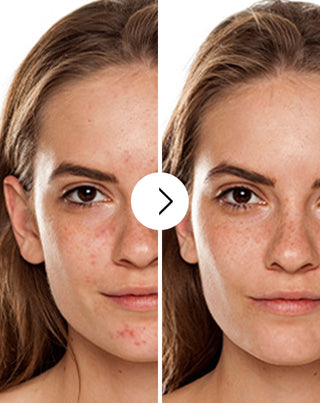 Acne, borbulhas e imperfeições em comprimidos com zinco, vitamina C, E e B2 Derminax_2 - 2