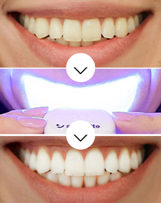 Set de albire a dinților cu lampă LED și gel de albire Light & Bright Smilebite - 3